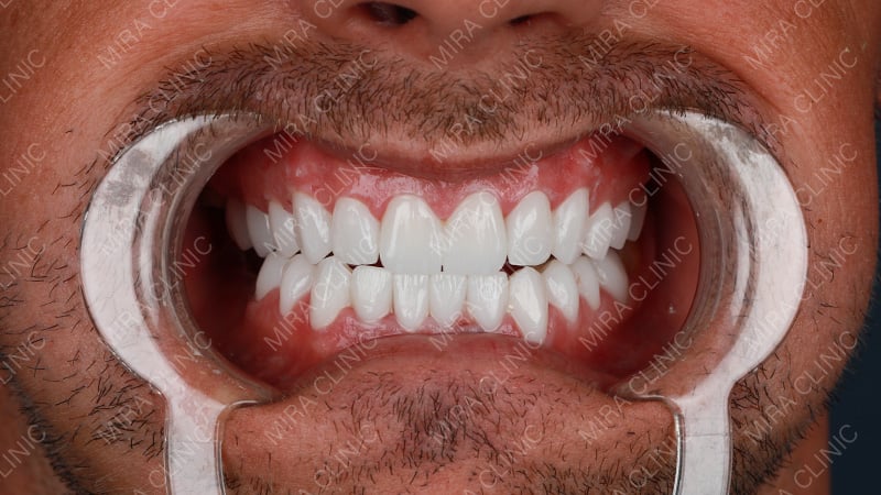 Correcting a Gummy Smile